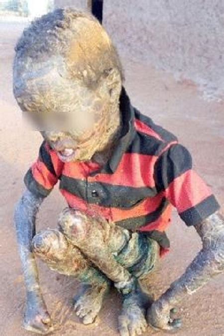 Omg See How These Children Look After Contracting Rare Skin Disease