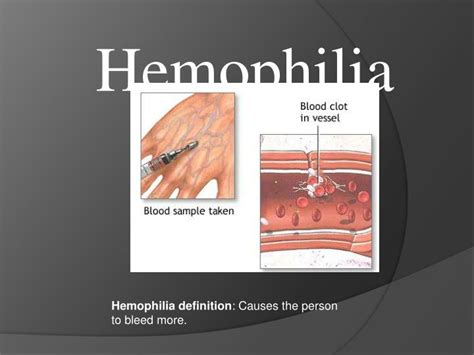 This is because a protein in their blood that's essential to clotting is either missing or doesn't work properly. PPT - Hemophilia definition : Causes the person to bleed ...