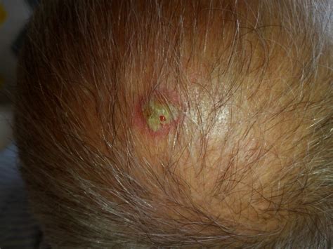 White Bumps On Head Scalp