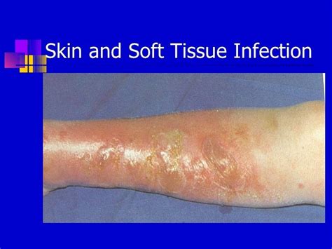 Skin And Soft Tissue Infections