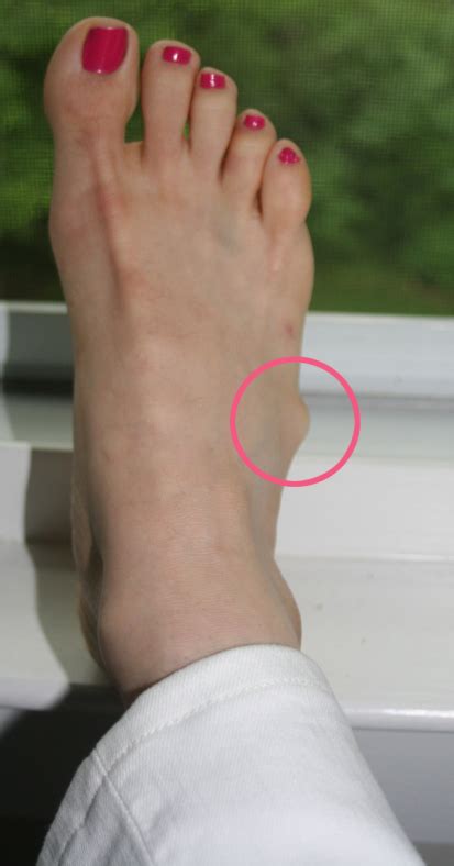 Ganglion Cyst On Bottom Of Foot Treatment Of Ganglion Cysts Some