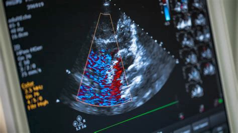 Echocardiogram What Is It Types Preparation And More