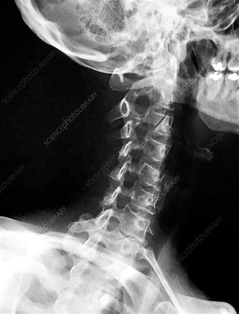 Normal Cervical Spine X Ray Stock Image C0393920 Science Photo
