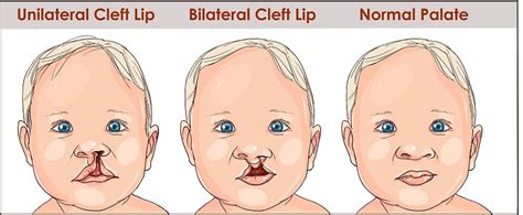 Cleft Lip And Palate Identification Causes And Treatment