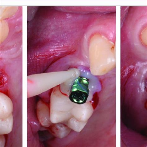 Advantages And Disadvantages Of Immediate Implant Placement And