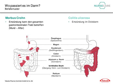 Mediziner nennen blutungen aus dem anus peranale. Grundlagen der CED | www.takeda-gastroenterologie.de/nursecare