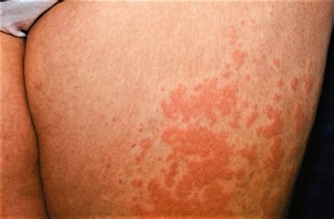 Polymorphous Light Eruption Lupus