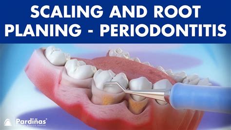 Treatment Of Periodontal Disease Scaling And Root Planing Tartar
