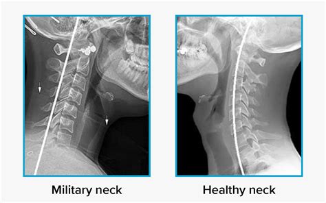 What Is Military Neck Or Cervical Kyphosis