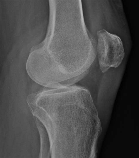 The 25 Best Sesamoid Bone Ideas On Pinterest Anatomy Of The Knee