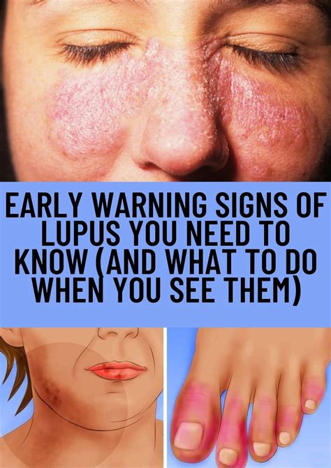 Early Warning Signs Of Lupus You Need To Know And What To Do When You