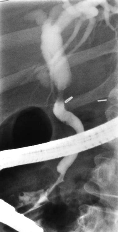 Endoscopic Therapy Of Anastomotic Bile Duct Strictures Occurring After