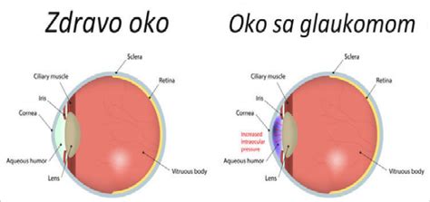 Ta Je Glaukom I Kako Nastaje Virtualnigrad