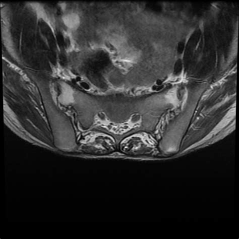 Ankylosing Spondylitis Image