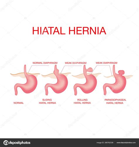 Hérnia hiatal Hérnia hiatal e anatomia normal do estômago imagem vetorial de Annakek
