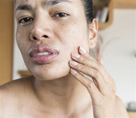 What Can I Do To Treat Dry Flaky Skin Quora