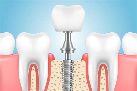 Dental Implant Process A Step By Step Guide