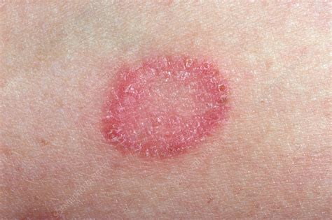Ringworm Fungal Infection Stock Image C Science Photo Library