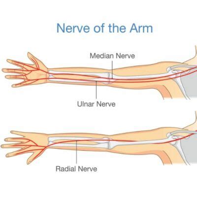 Median Nerve Compression Pronator Syndrome Anterior Interosseus