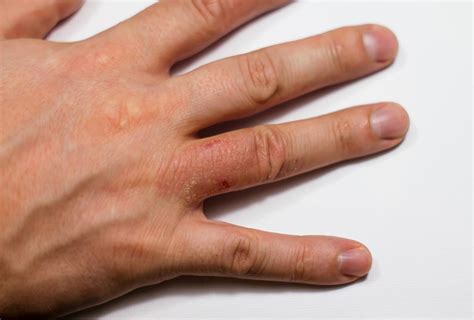 Eczema Types Causes Symptoms And Medical Treatment