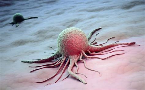 Cancer Cells With Cytoplasmic Projections — Malignancy Oncology