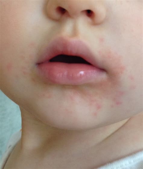 Rash Around Toddlers Mouth Pictures Photos