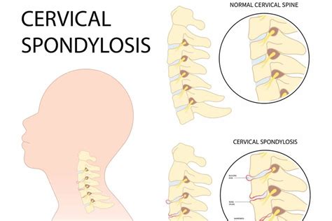 Cervical Spondylosis Symptoms Causes And Treatments Available