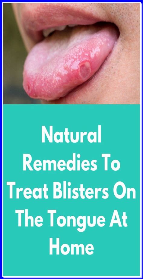 Natural Remedies To Treat Blisters On The Tongue At Home Natural