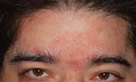 Seborrheic Dermatitis On Eyelids