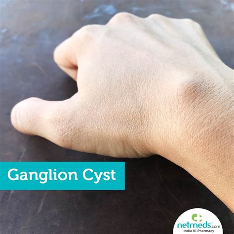 How To Aspirate A Ganglion Cyst At Home Grizzbye