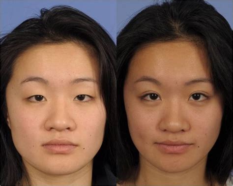 Asian Double Eyelid Surgery Before And After 22 Young Woman Plastic Surgery Nose Surgery