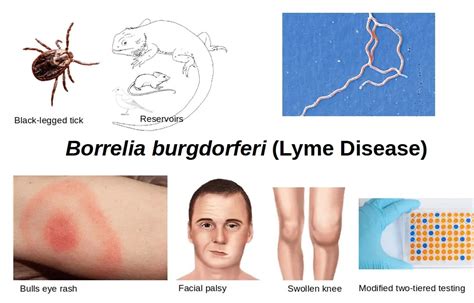Borrelia Burgdorferi Lyme Disease Clinical Features Diagnosis