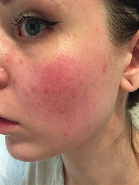 Skin Concerns Is This Rosacea My Face Looks Like This