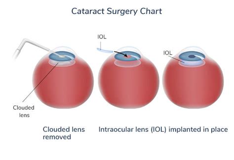 Cataracts Houston Tx Cataract Surgery Pasadena Tx Houston Eye