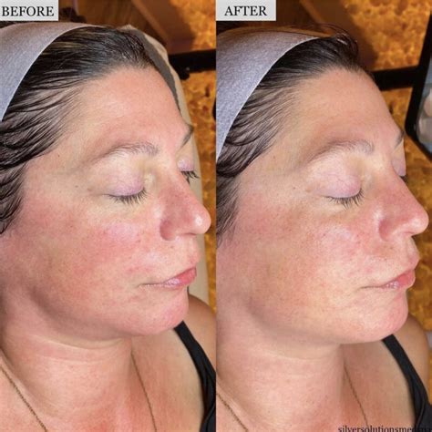 Hydrafacial Before And After Gallery Silver Solutions Medspa