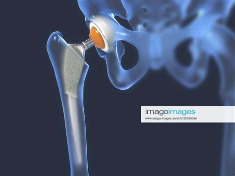 Hip Replacement Illustration Hip Replacement Illustration