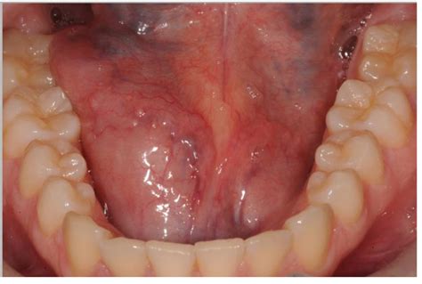 Epidermoid Cyst Presenting In The Floor Of The Mouth Hania Journal