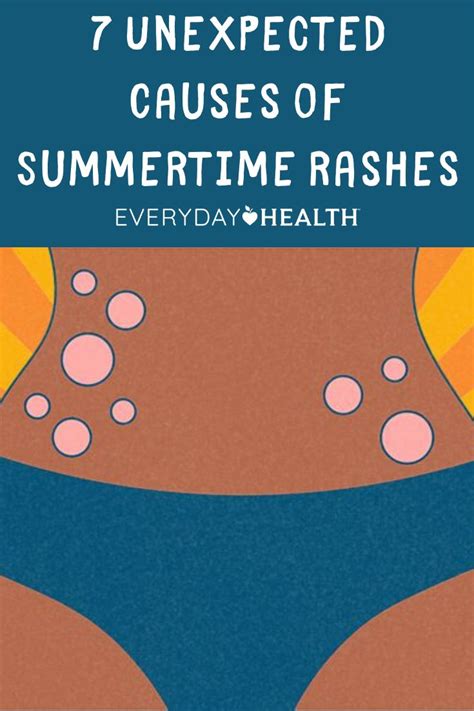 Causes Of Summertime Rashes Everyday Health In 2020 Intense Itching