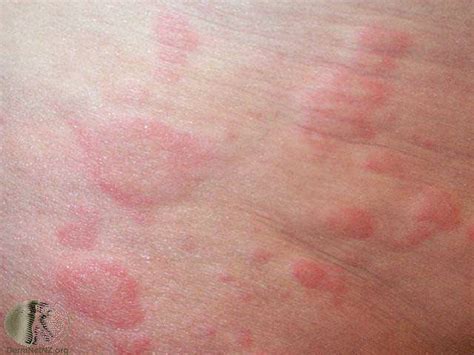 Hives Treatment Urticaria Treatment Colorado Springs And Monument