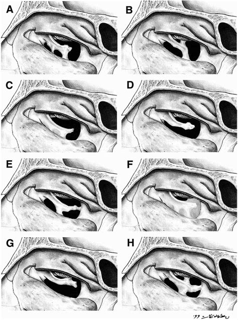 Fontanelle And Uncinate Process In The Lateral Wall Of The Human Nasal