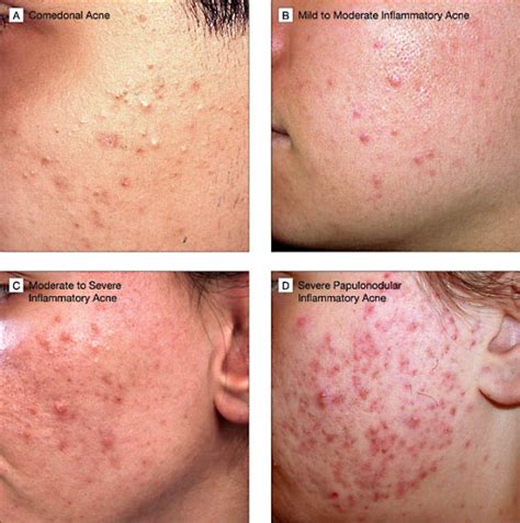 Dermhelpcentral Overview Of Acne Therapy
