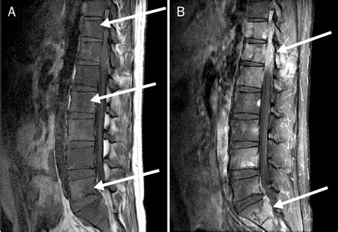 White Spots On Mri Lumbar Spine