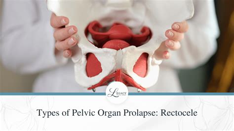Types Of Pelvic Organ Prolapse Rectocele Legacy Physical Therapy
