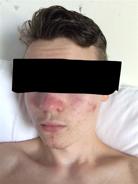 Red Facenose After Shower Rosacea By Jakobs Rosacea And Facial