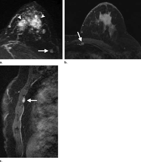 Two Synchronous Masses Of Invasive Ductal Carcinoma In The Left Breast
