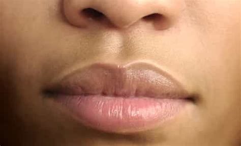 Lips Discoloration Causes And Treatment