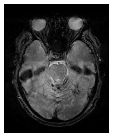 T2 Weighted Gradient Echo Mri Of The Brain Superficial Siderosis With