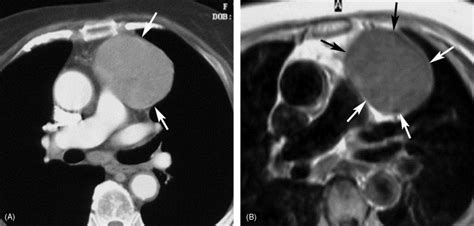 Thymic Epithelial Tumors Comparison Of Ct And Mr Imaging Findings Of