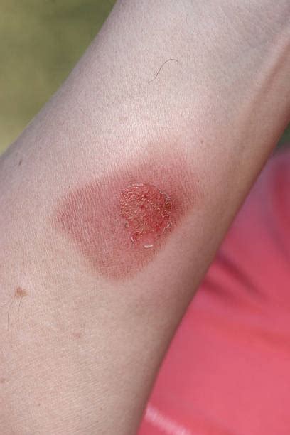 Skin Burn Stock Photos Pictures And Royalty Free Images Istock