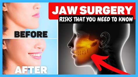 Corrective Jaw Surgery Recovery And Cost Dentist Review Of Orthognathic